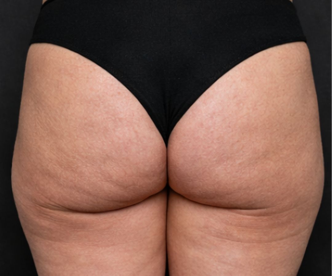 Antes del tratamiento de Bioestimulador Corporal en Gluteos