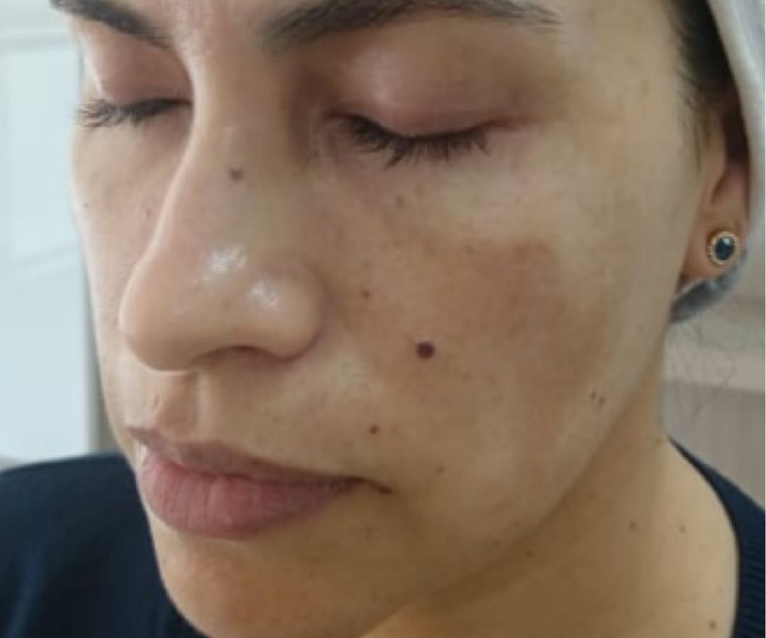 Antes del tratamiento de Exosomas en Rostro