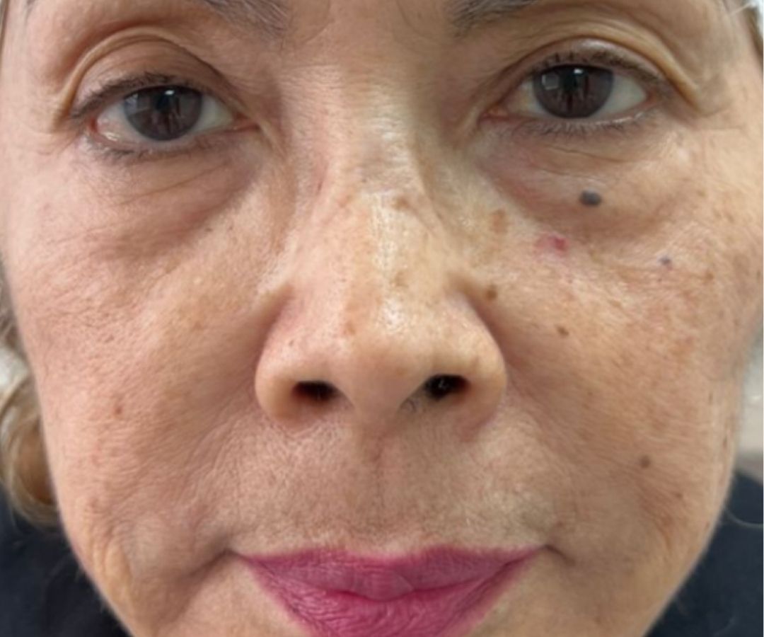 Antes del tratamiento de NCTF en Facial