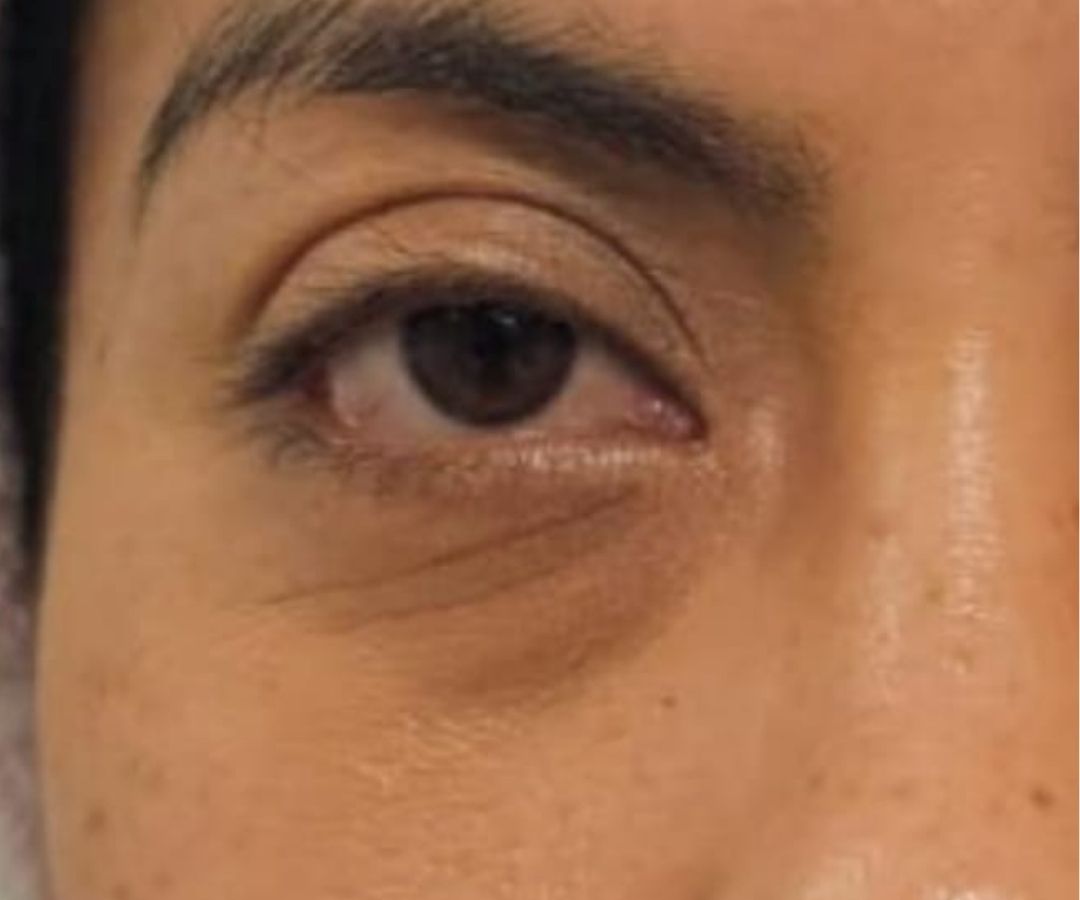 Antes del tratamiento de NCTF en Ojos