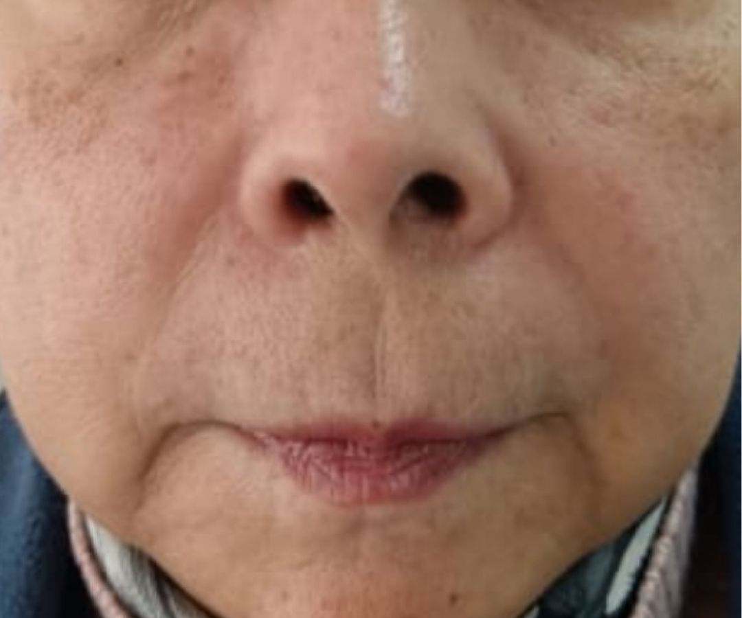 Después del tratamiento de Exosomas en Rostro