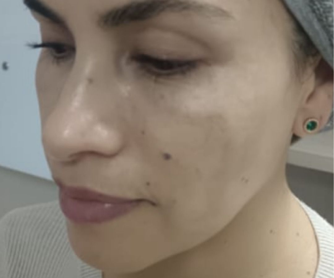 Después del tratamiento de Exosomas en Rostro