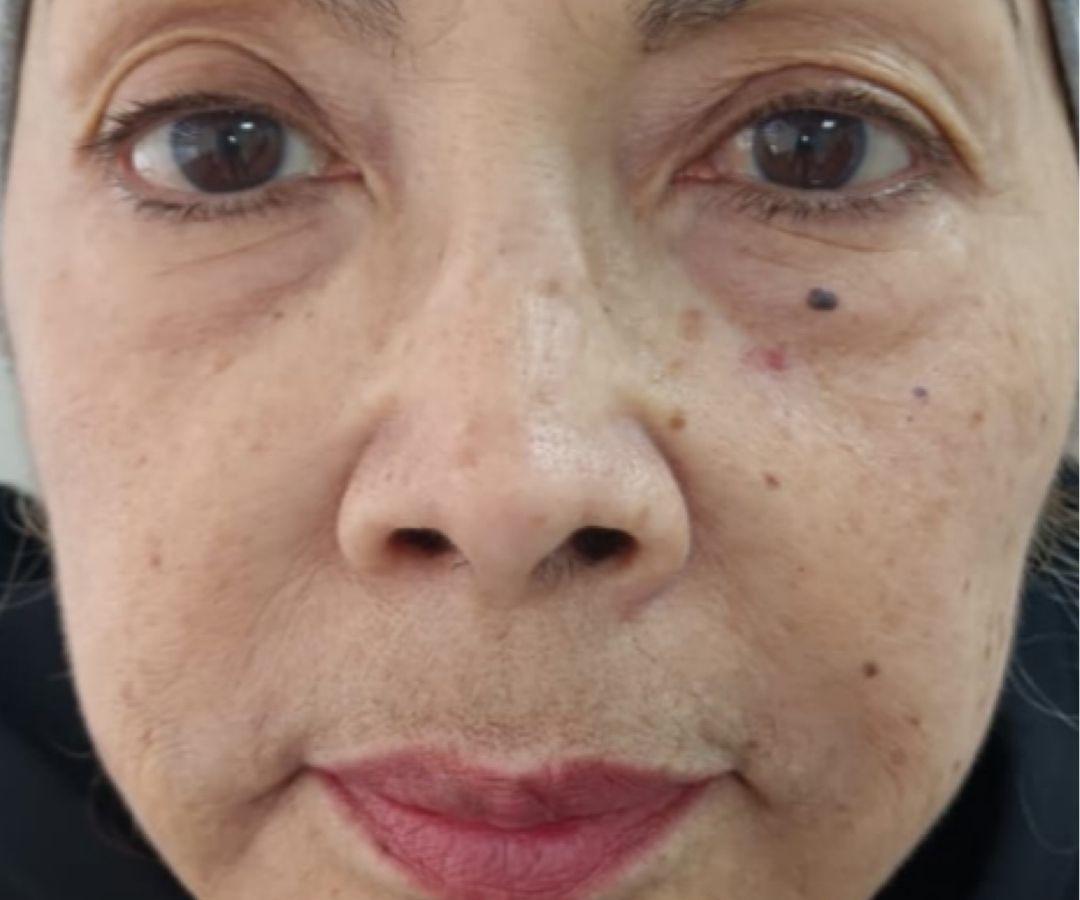 Después del tratamiento de NCTF en Facial