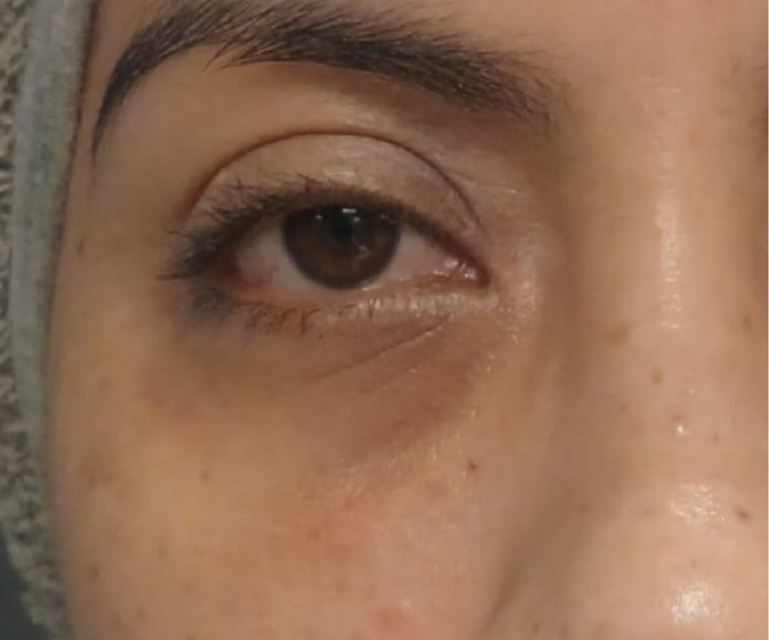 Después del tratamiento de NCTF en Ojos