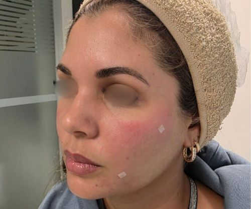 Después del tratamiento en Bioestimulador de Colágeno en Cuidamedic